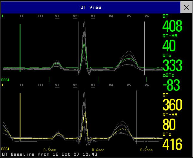 About QT/QTc Interval Monitoring 7 ECG, Arrhythmia, ST and QT Monitoring QT View Changing the lead(s) used for QT measurements will not cause the baseline to be reset.