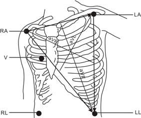 5-Leadwire Electrode Placement Following is an electrode configuration when using 5 leadwires: RA placement: directly below the clavicle and near the right shoulder.