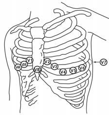 The chest (V) electrode can be placed on one of the following positions: V1 placement: on the fourth intercostal space at the right sternal border.