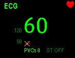 Heart beat symbol 3. Current heart rate For 12-lead ECG display screen, refer to section 8.9 12-Lead ECG Monitoring. 8.5 