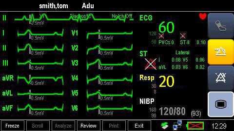 8.9 12-Lead ECG Monitoring 1. Refer to section 8.3.3 ECG Lead Placements for placing the electrodes. 2. In the [ECG Setup] menu, select [Lead Set] [12-Lead]. 3.