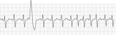 ECG HR 87 IRREGULAR IRREGULAR This occurs when six consecutive normal R-to-R intervals vary by 100 milliseconds or more.