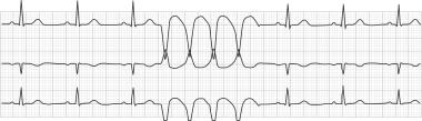 0 2 Years: Greater than or equal to 160 beats-per-minute 3 10 Years: Greater than or equal to 140 beats-per-minute 11 13 Years: Greater than or equal to 130 beats-per-minute VT > 2 Adult: Ventricular