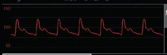 > Adjust MEAN and AMPLITUDE NOTE of BP and Pulse in case trends are not visible within scale range.