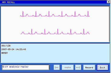 4.2.4 ARR Review Click and open the dialog of arrhythmia review and the arrhythmia data for 8 seconds are displayed on each screen, i.e. the ECG waveforms 4 seconds before and after the occurrence of the event, and a maximum of 128 groups of abnormal data can be stored for search.