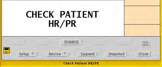Directions for use Chapter 5 Respond to alarms and alerts 89 Dismiss a CHECK PATIENT HR/PR alert A patient monitor uses a single lead to calculate heart rate, and an Acuity System with an Arrhythmia