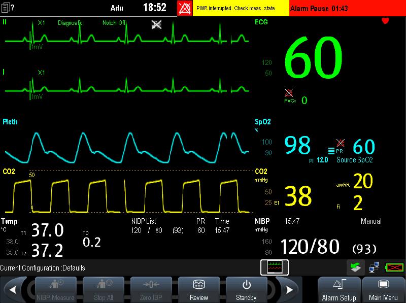 2.5 Display Screen This patient monitor adopts a high-resolution LED screen to display patient parameters and waveforms. A typical display screen is shown below. 1 2 3 4 5 6 7 8 9 1.