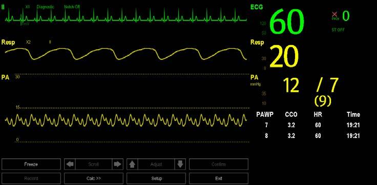 14.6 Measuring PAWP Pulmonary Artery Wedge Pressure (PAWP) values, used to assess cardiac function, are affected by fluid status, myocardial contractility, and valve and pulmonary circulation