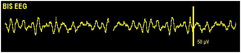 23.3.2 BIS Waveform Area The BIS waveform area allows you to view either EEG waveform or BIS trend. A secondary parameter s trend line can also be displayed together with BIS trend line. 1.