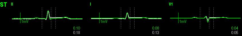 The current ST segment is drawn in the same color as the ECG wave, usually green, superimposed over the stored reference segment, drawn in a different color.