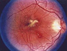 Q-Switched Laser Injury Retinal
