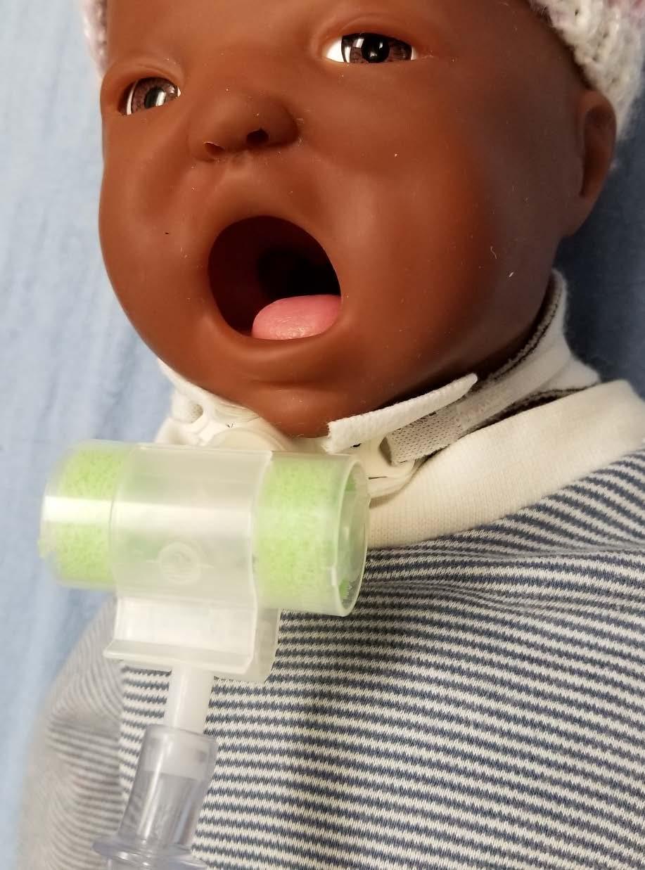 HME Types 5/25/2017 Hydro-Trach T: Can be used for children with smaller lung volumes who require entrained oxygen if they can t tolerate the Thermovent T Sponge wick system to