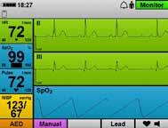 Thanks to the integrated 6-lead ECG, all the ECG leads relevant for patient monitoring are available.