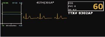 Multi-Patient Viewer - Patient Window C B D A A. ECG Waveform and Lead Label: A maximum of four waveforms can be displayed in the patient window.