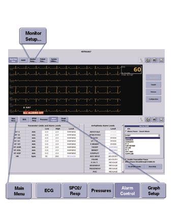 MUSE Cardiology System Assistance Monitor Setup Once you admit a patient to the CIC Pro, there may be several things you would like to do to customize the patient s parameter control settings or