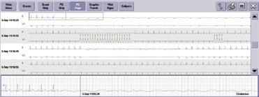 Full Disclosure- FD Page The FD page allows you to view and examine the full range of stored waveforms, zoom in on an area of interest, and print a customized Full Disclosure Report. A E F G B D MD.
