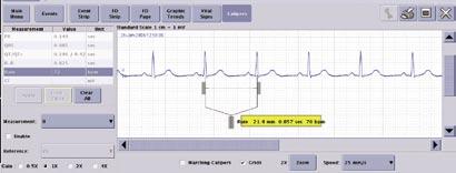 Calipers When full disclosure data is collected and stored at the CIC Pro, you can use the Calipers measurement tool to measure PR, QRS, QT and R-R waveform intervals and the ST waveform amplitude.
