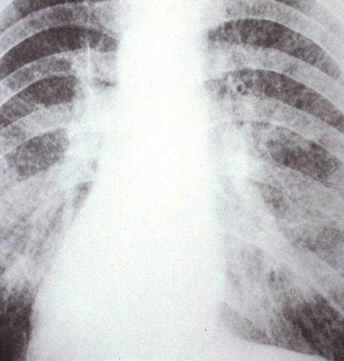 THE PRIMARY - ASBESTOS-RELATED DISEASES Asbestosis Scarring of lungs; irreversible damage Requires extended and very high levels of exposure (fewer cases seen nowadays) Lung Cancer Caused by various