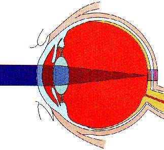 The human eye can focus even a low-power laser beam to a
