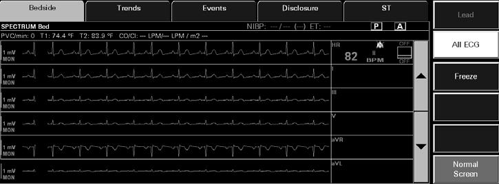 1 Accessing the All ECG View To access the All ECG view (shown in FIGURE 7-4), select the All ECG sidebar button from the Bedside tab All Waveforms view.