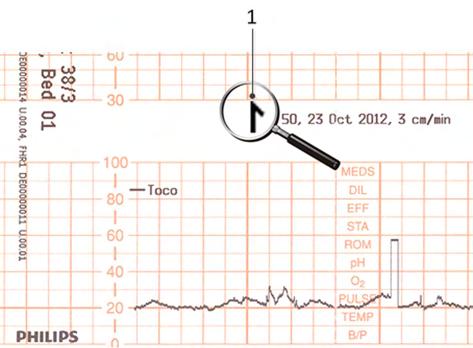 3 Basic Operation 1 Time stamp printed every ten minutes The trace records maternal parameters also. When measuring noninvasive blood pressure, the annotation is made at the end of the measurement.