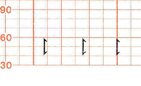 3 Basic Operation A small arrow is printed on the heart rate scale on the trace paper.