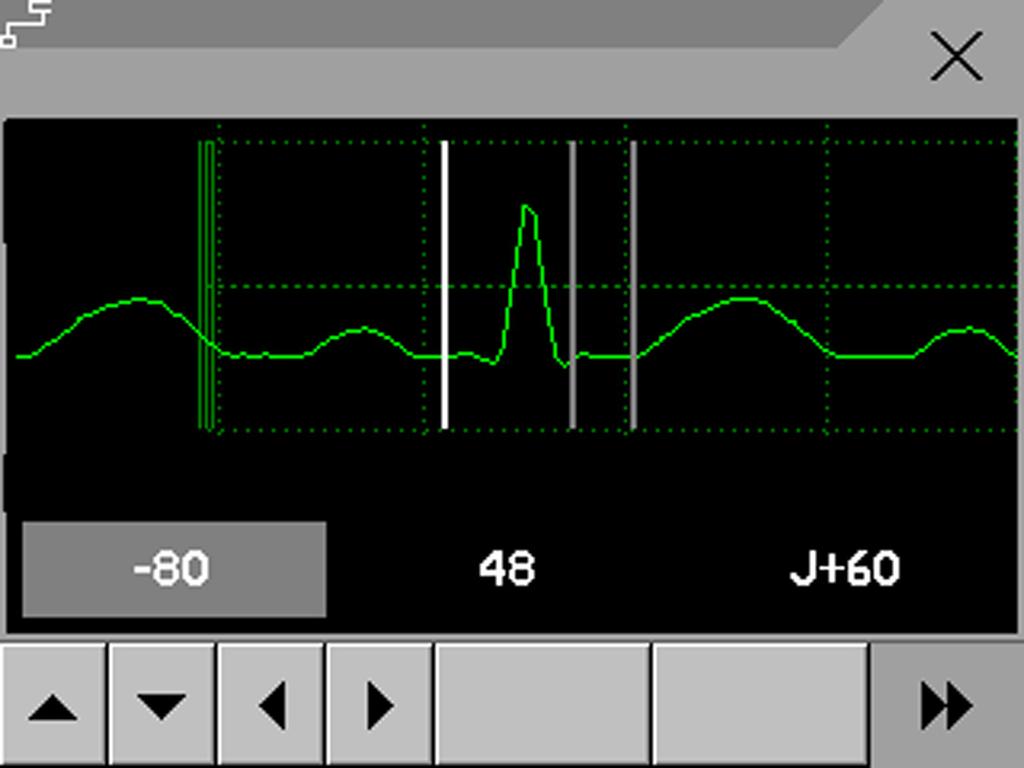 About the ST Measurement Points 7 ECG, Arrhythmia, ST and QT Monitoring 3 Select the ST point you need to adjust by touching the appropriate point on the screen.