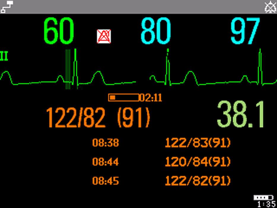 Example of other graphical screen trends: ABP SBed9 Adult ALARMS OFF