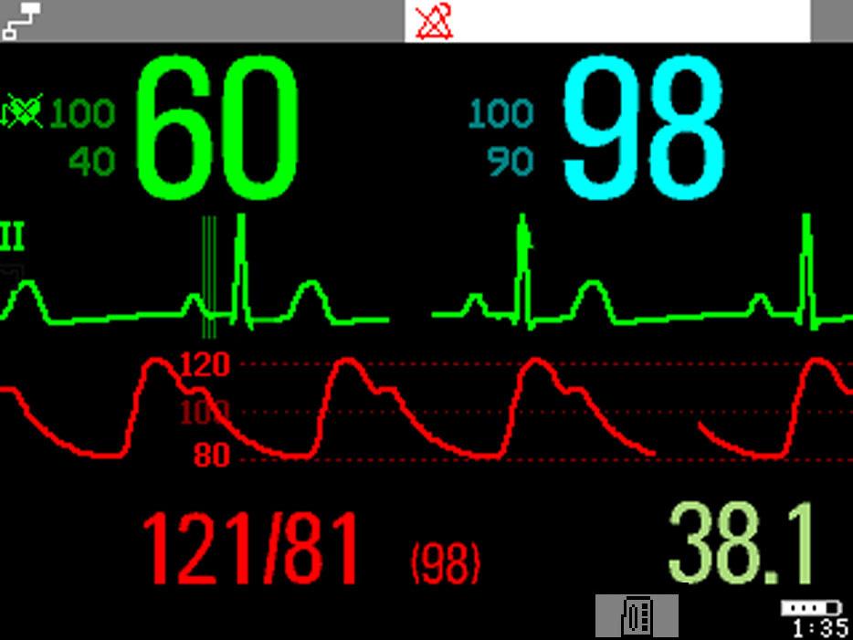 2 Basic Operation Operating and Navigating A typical main screen looks like this: 5 6 4 3 Bed9 Adult ALARMS OFF HR SpO 2 2 1 7 8 M ABP 11 1mV Sinus Rhythm ABP Sys.