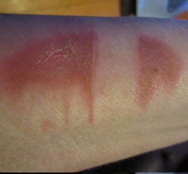 a. If it is a FIRST degree burn, it will be red, but there