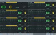 bedside monitors waveforms simultaneously. Selectable Dualscreen display.