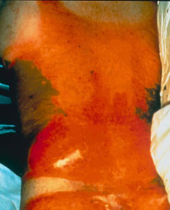 Clothed areas can be more severely burned than exposed skin!