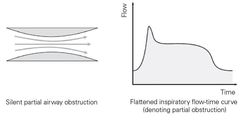 Flow limitation As the upper airway begins to collapse, the shape of the inspiratory flow-time curve changes.