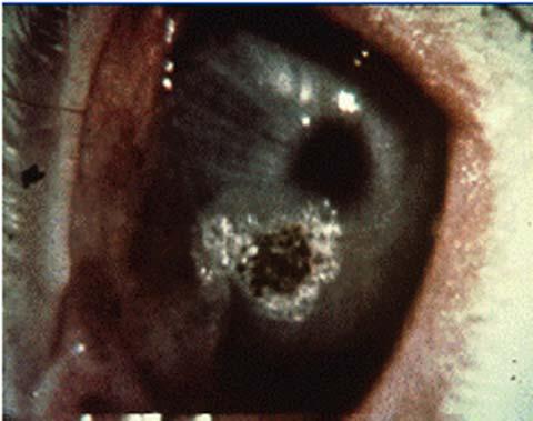 04 m NIR Detected by dilating eyes and inspecting back of eye Corena