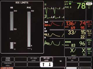 Limits: To Change the ECG Alarm Limit: Select ECG. Select ECG LIMITS.