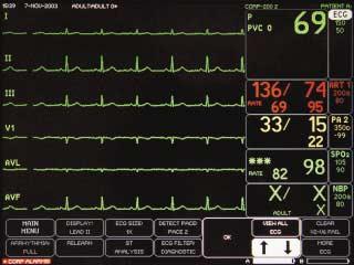 View All ECG: Allows six leads of ECG to be viewed on the display. To View All ECG: Select ECG. Select VIEW ALL ECG. Six waveforms will be displayed. Press GRAPH GO/STOP to print displayed leads.