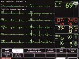 (continued from previous card) ST 12 Lead ECG Select 12 LEAD ECG NOW. Message appears: PERFORMING ANALYSIS.