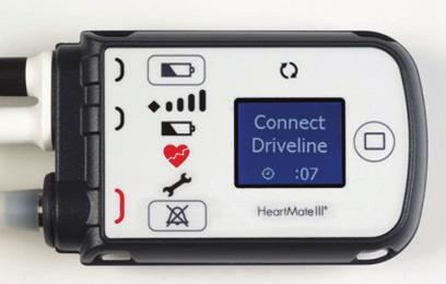 HeartMate III with Pocket Controllers 1. Can I do external CPR? Only if absolutely necessary 2. If not, is there a hand pump or external device to use? No. 3.